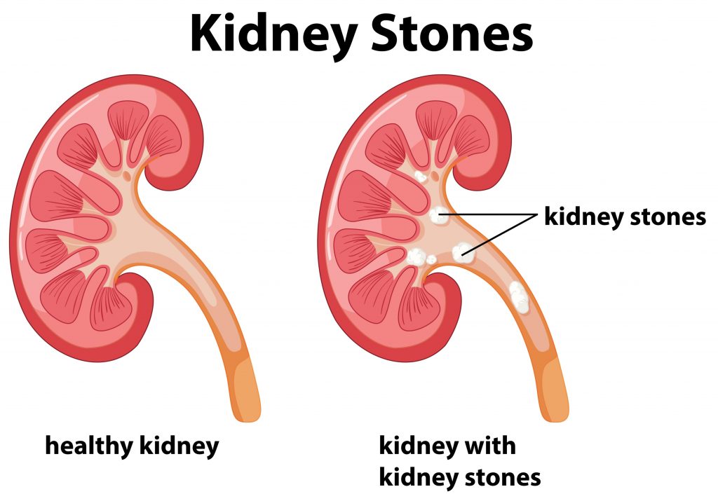 Kidney Stone Treatment In Hoshiarpur