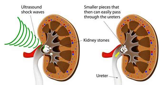 KIDNEY STONE TREATMENT HOSPITAL IN JALANDHAR