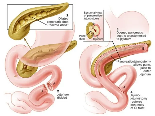LAPAROSCOPIC ADRENALECTOMY SURGERY IN INDIA 